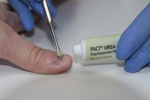 urea for nail